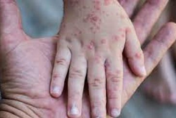 Exhorta a Salud a informar sobre viruela símica